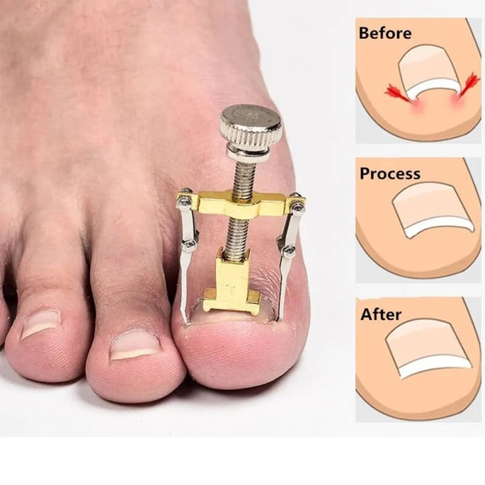 Correct Paronychia With Toe Nail Correction Bracket Care